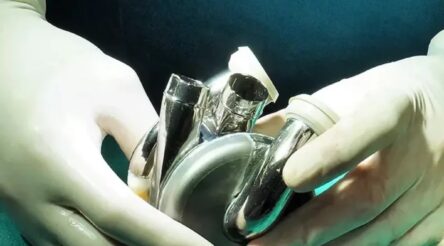 Image for Unnamed patient becomes first outside of US to receive maglev artificial heart